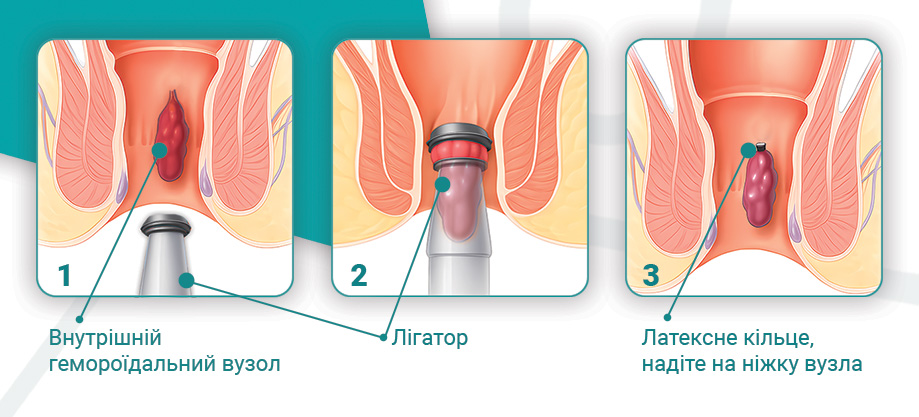 Інфографіка геморой латекс.jpg лигирование геморроя