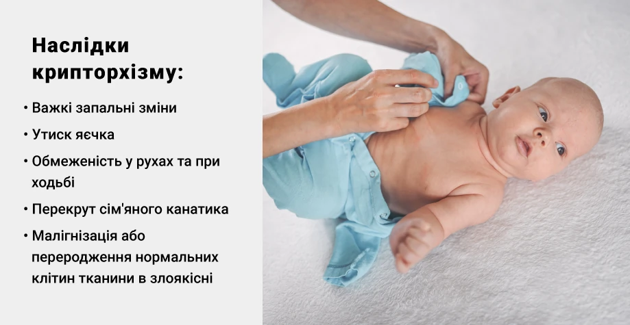 Неопущение яичка