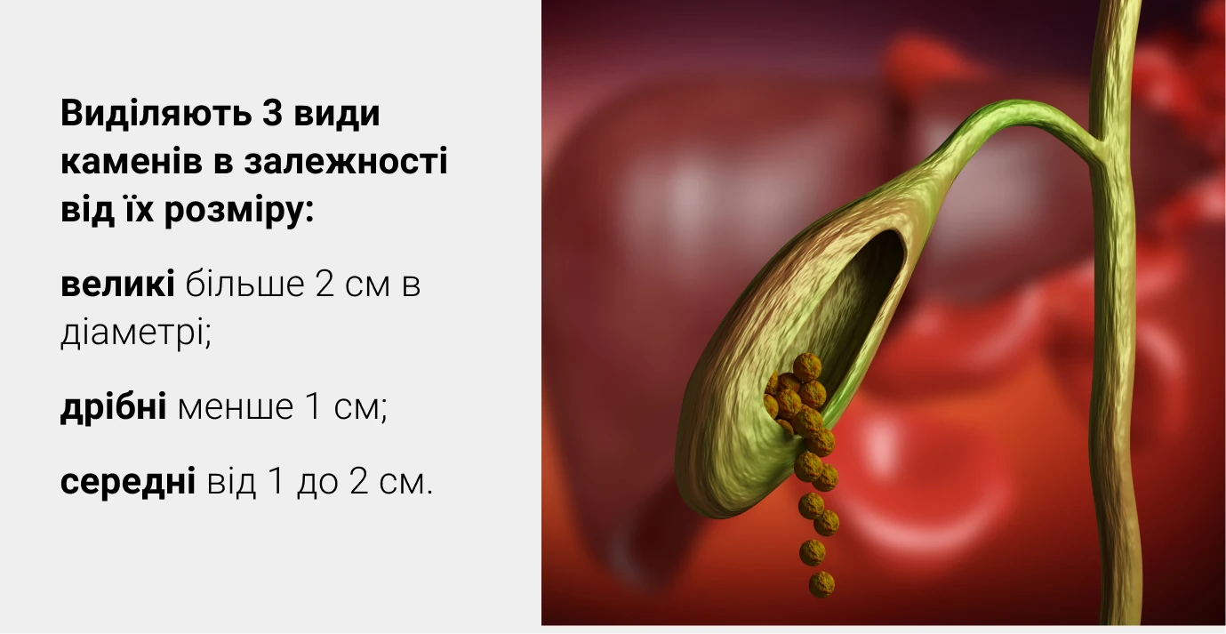 Камені в жовчному