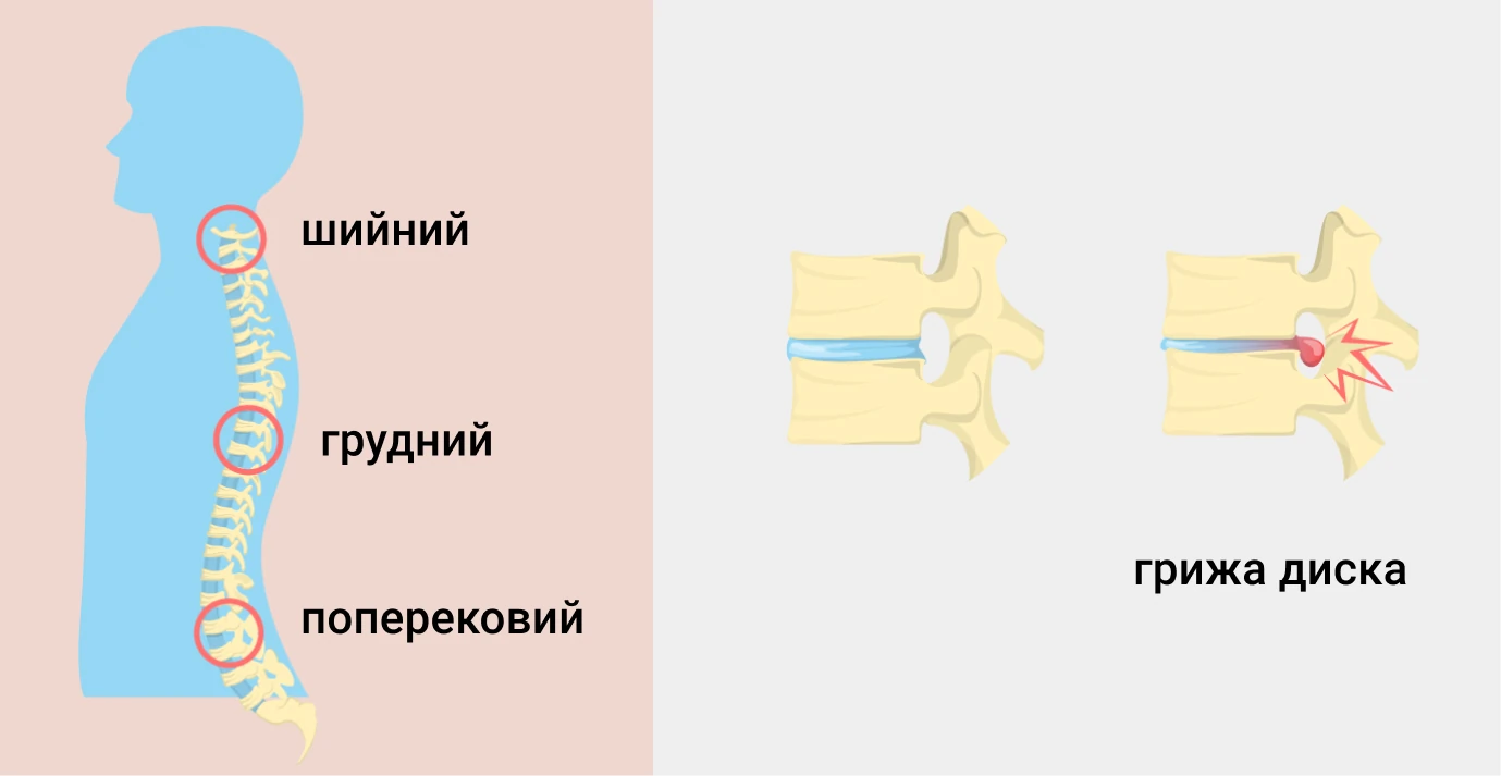 Лечение остеохондроза