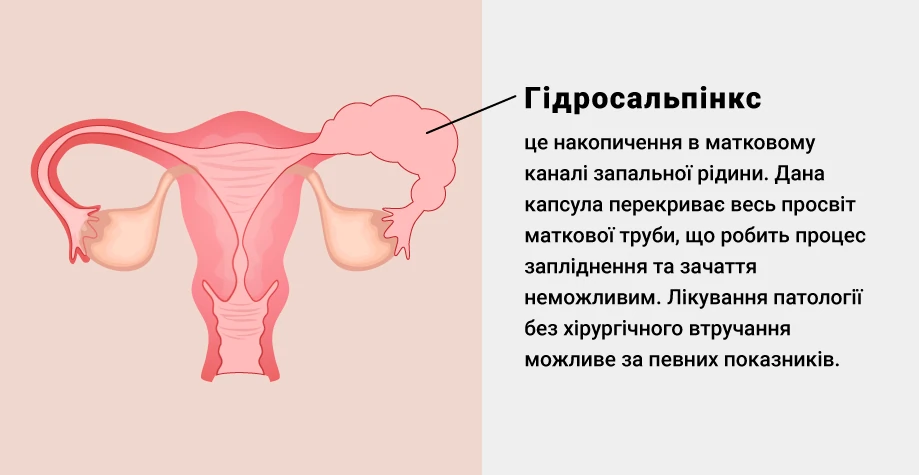 Гидросальпинкс