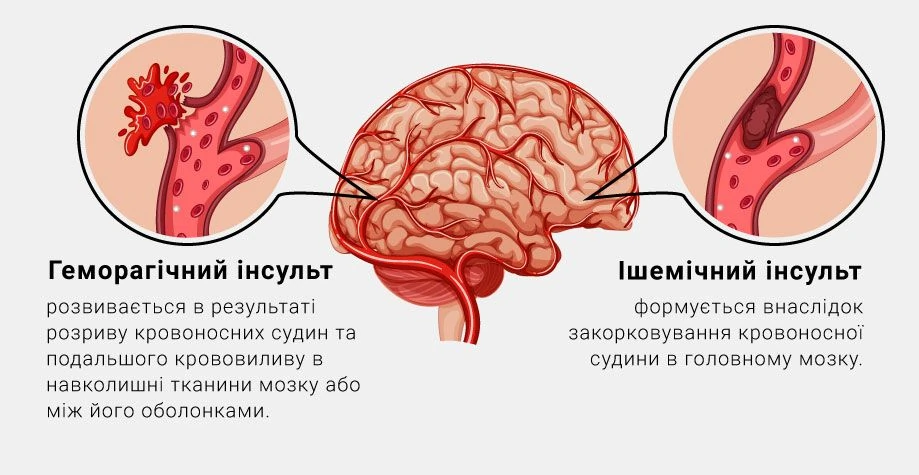 Геморрагический и ишемический инсульт