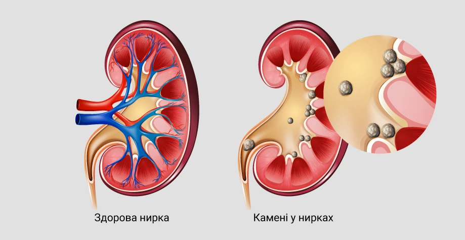 Хвороби нирок