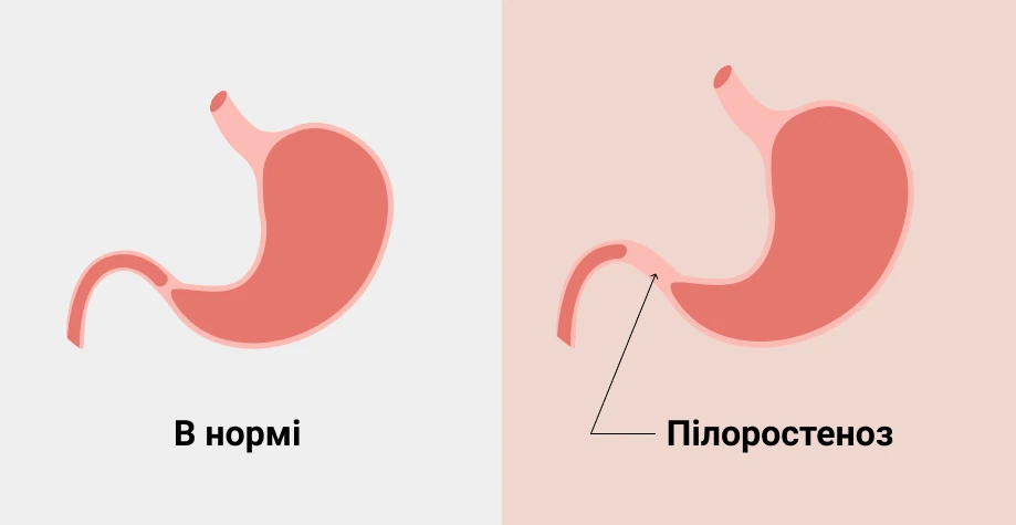 Пилоростеноз
