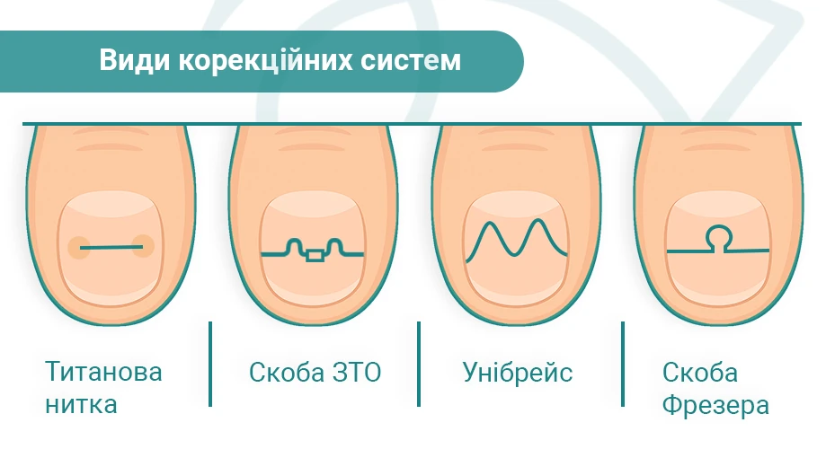 Види корекційних систем.png коррекция ногтя