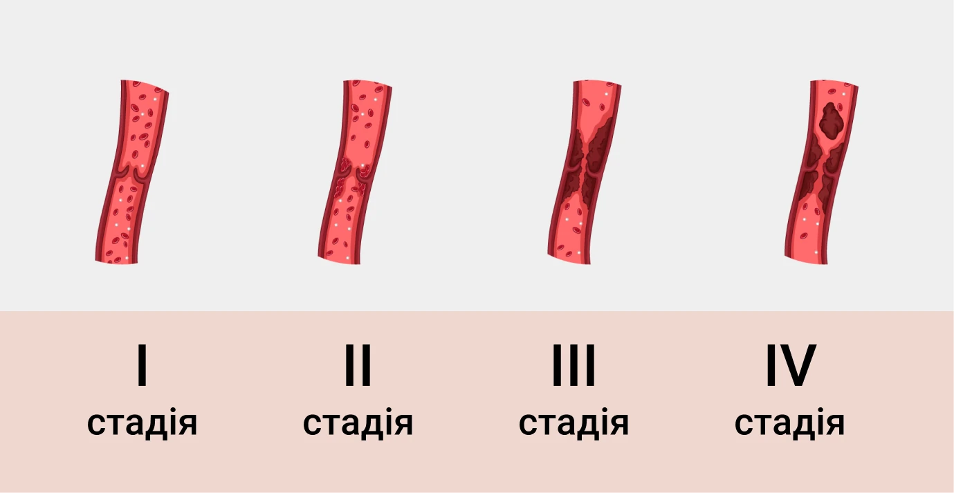 Флебіт