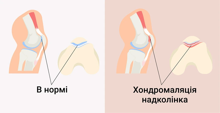 Патогенез хондромаляции