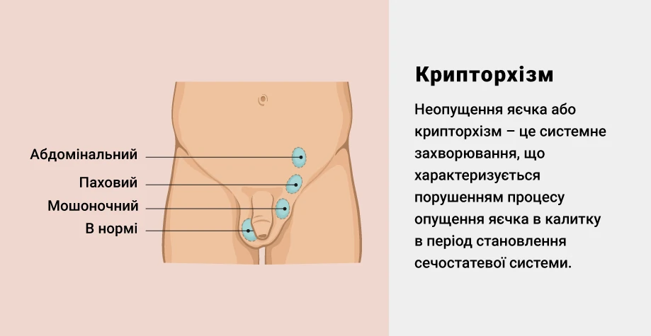 Крипторхизм