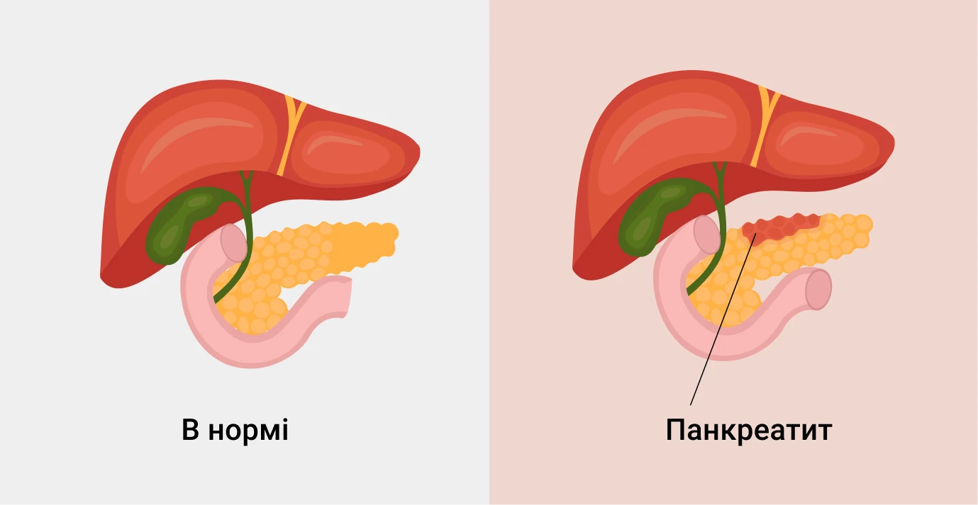 Лечение панкреатита