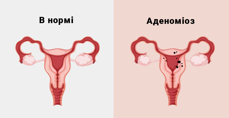 Миома матки в сочетании с аденомиозом