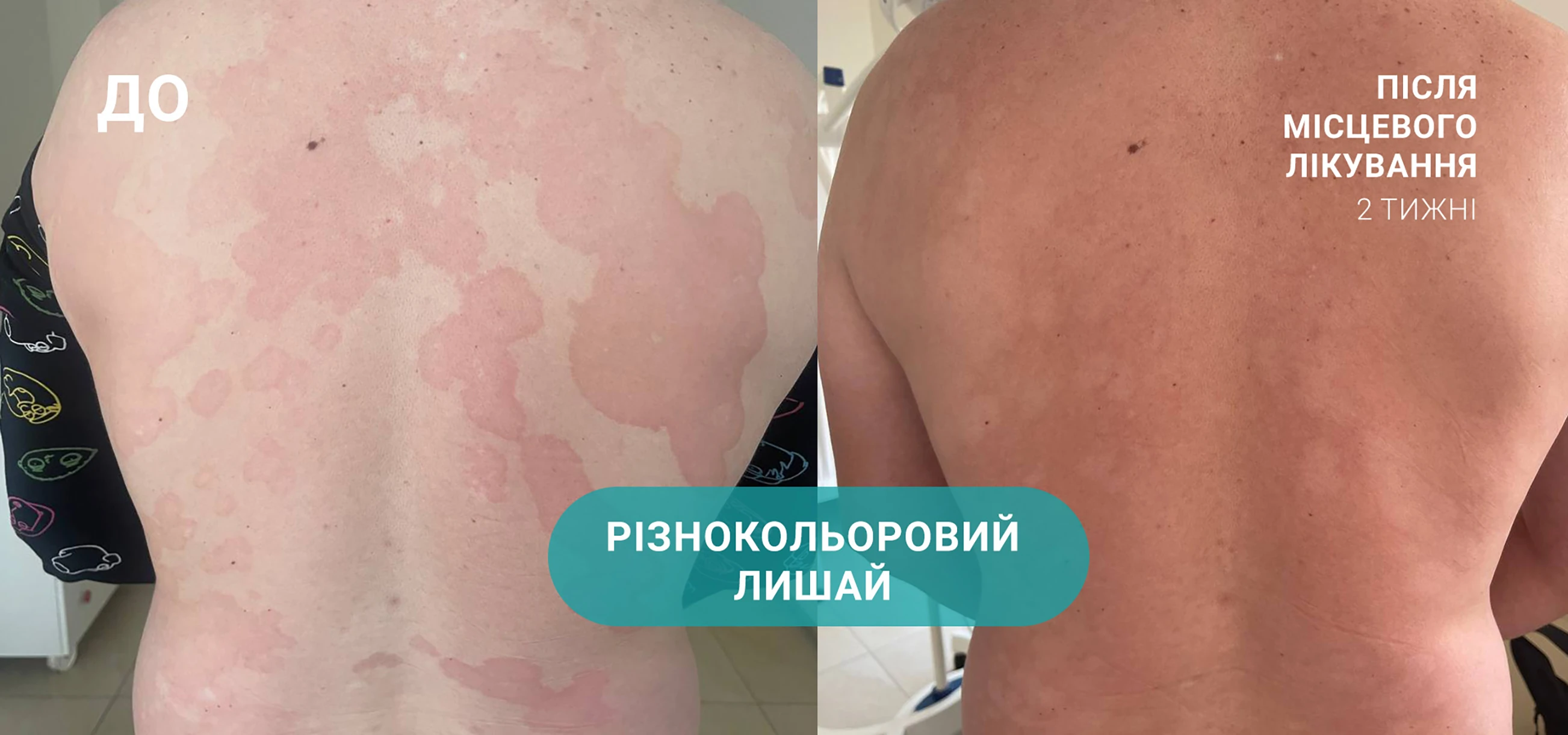 лікування лишаю
