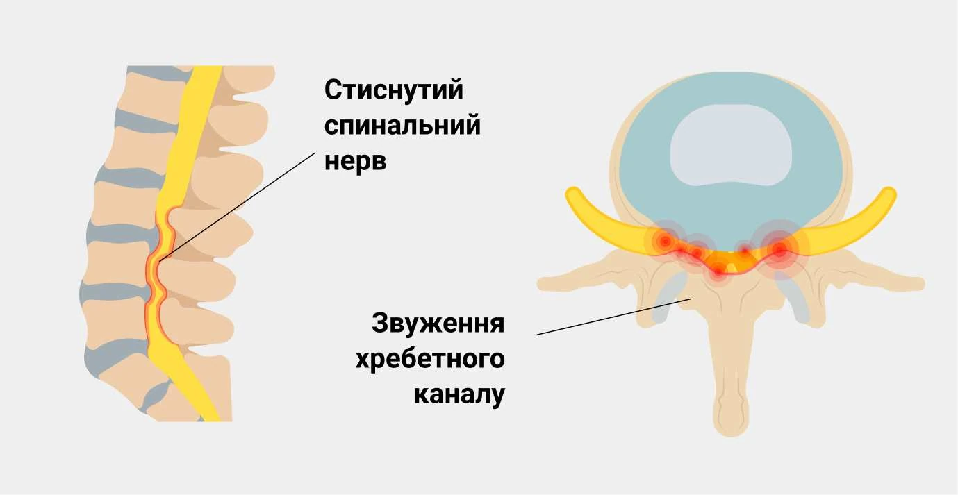 Люмбаго