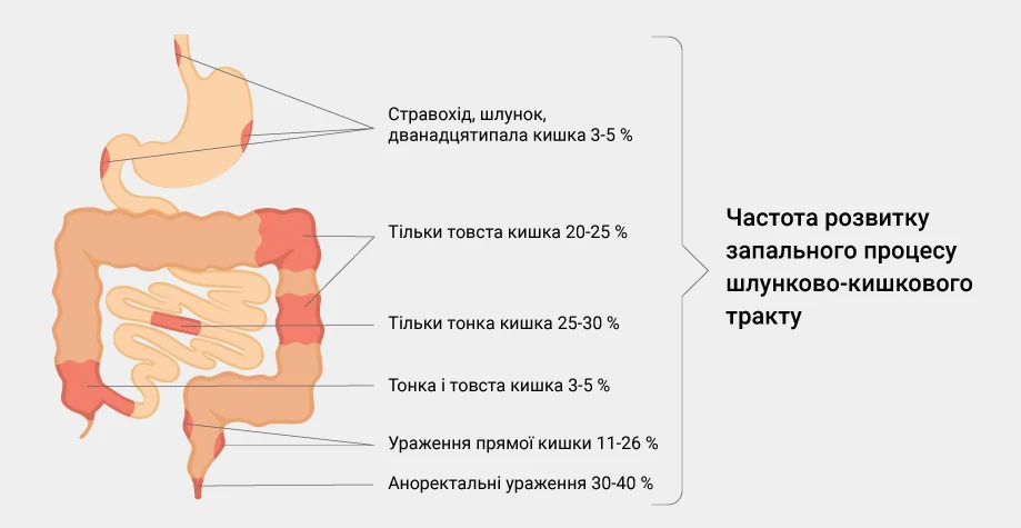 Болезнь Крона