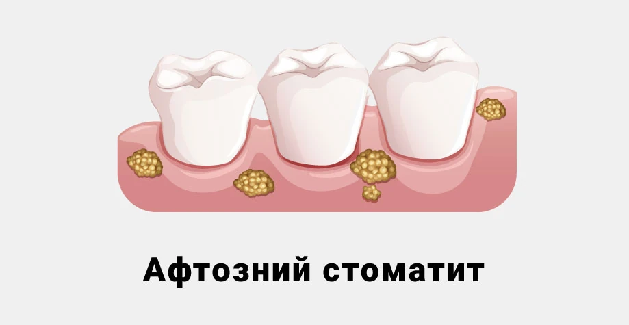 Стоматит