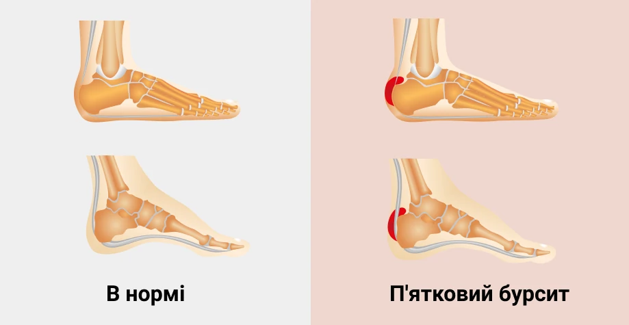П'ятковий бурсит