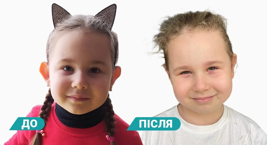 отопластика детям до-после