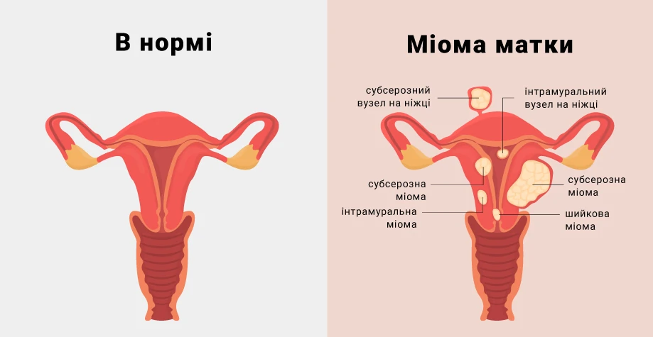 Миома матки