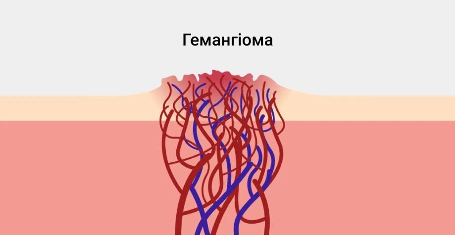 Гемангиома