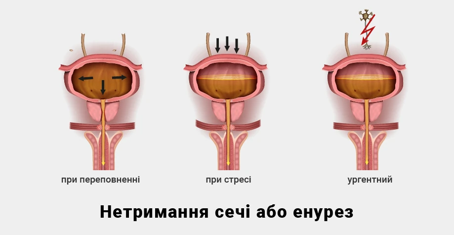 Энурез