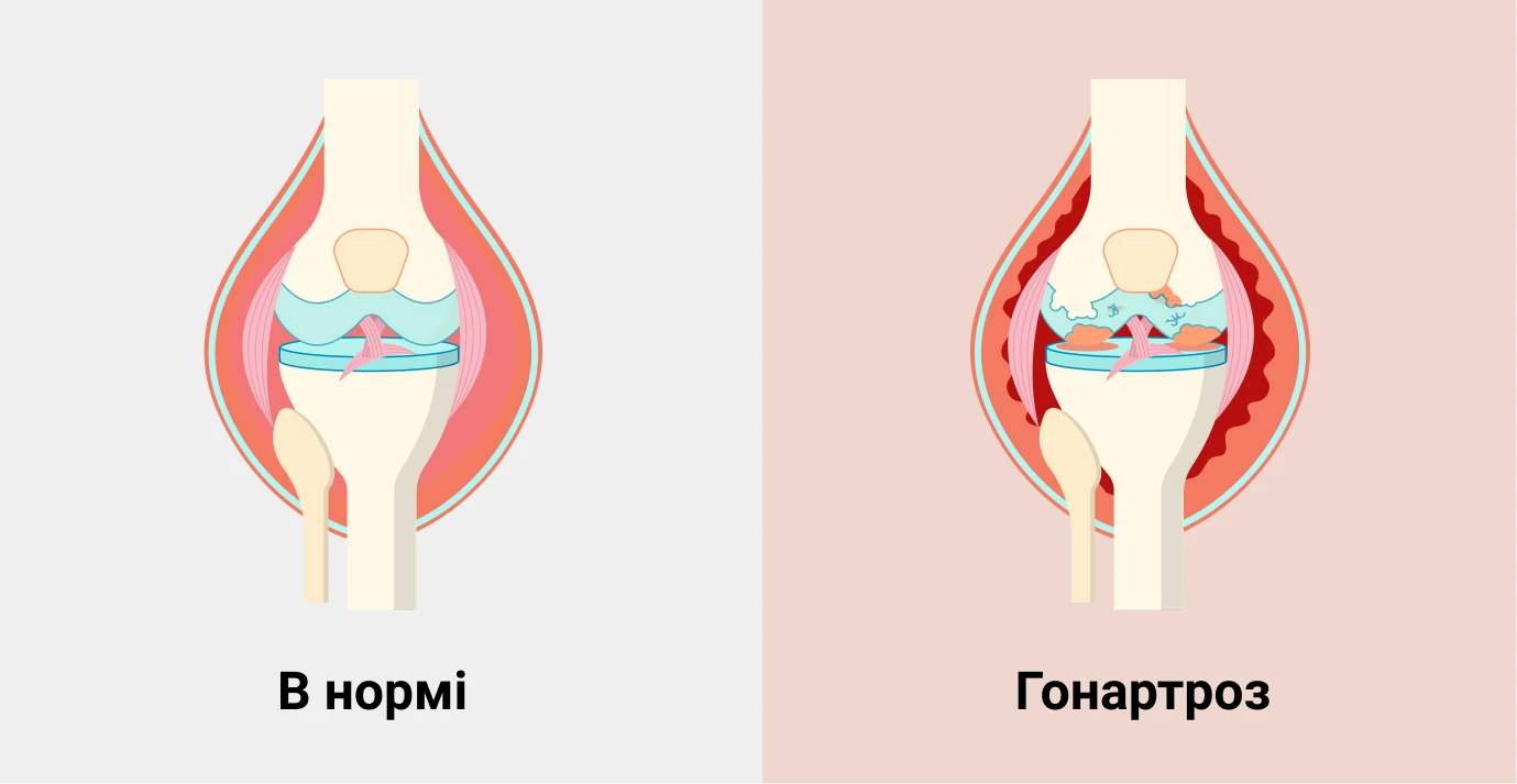 Гонартроз
