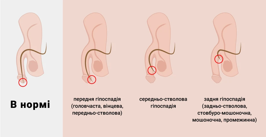 Гіпоспадія