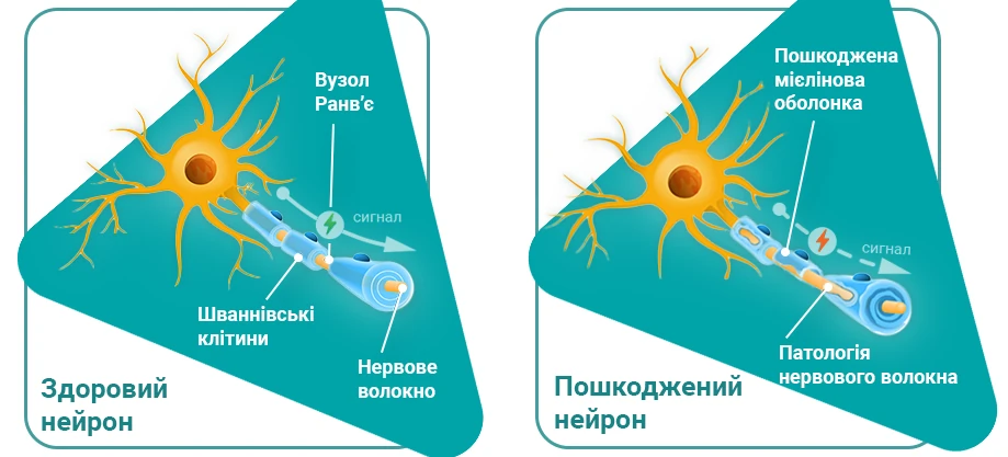 прояв розсіяного склерозу прояв розсіяного склерозу