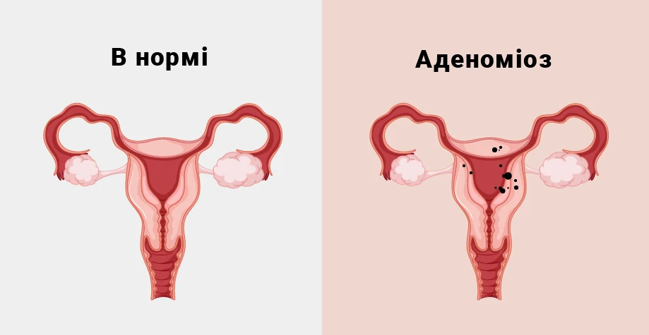 Аденоміоз
