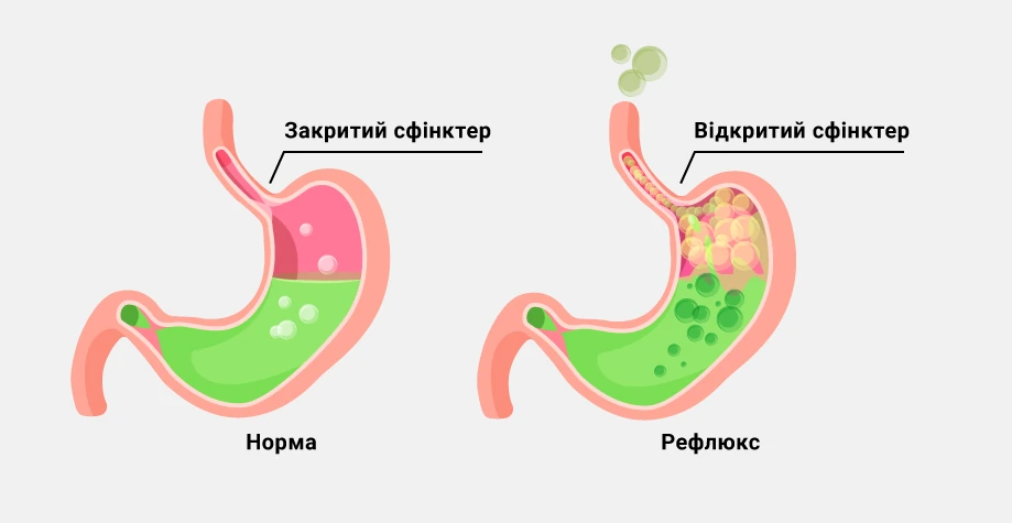 Метеоризм