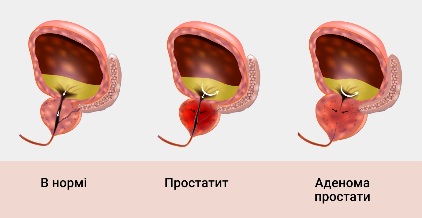 adénome prostate et psa)