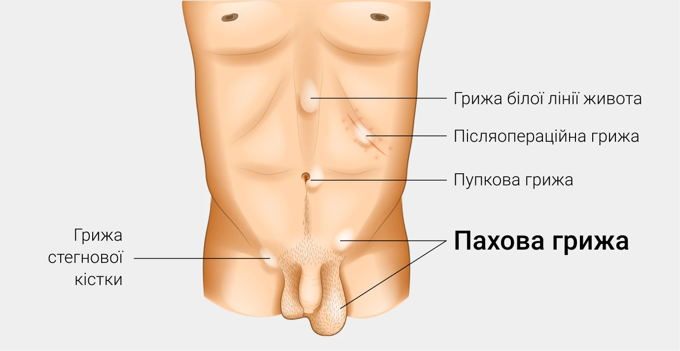 Лікування пахової грижі