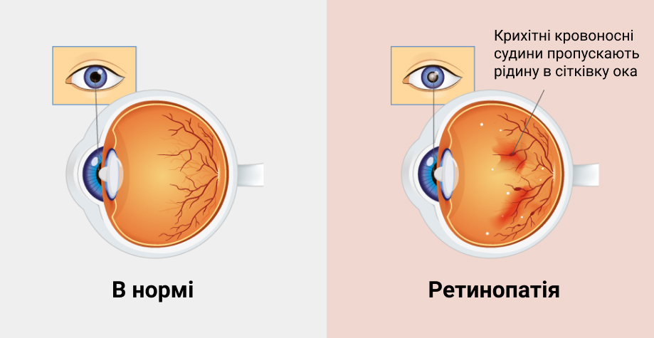 Патогенез ретинопатії