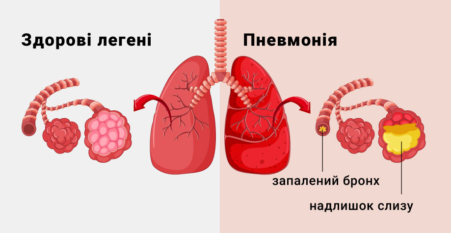 Лечение пневмонии у детей