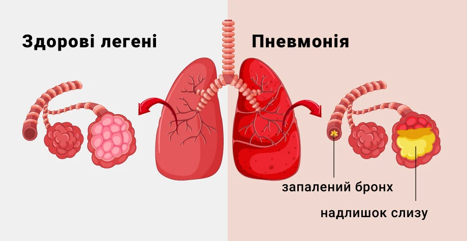 Пневмонія