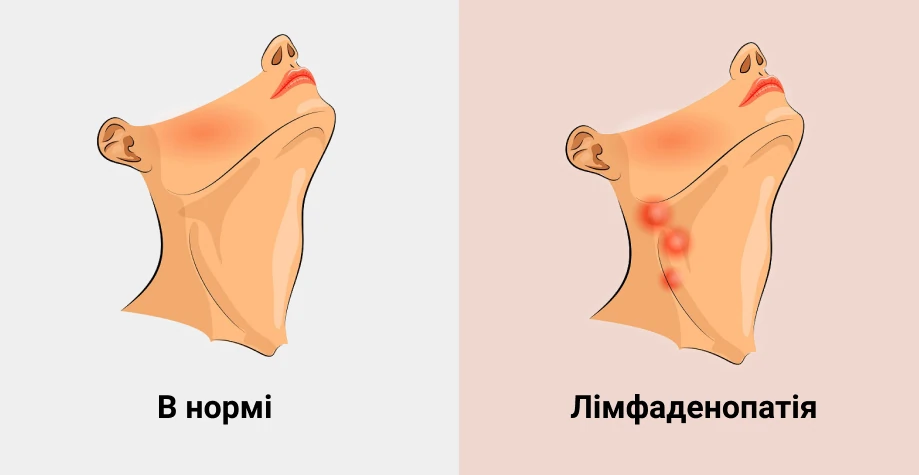 Патогенез лимфоденопатии