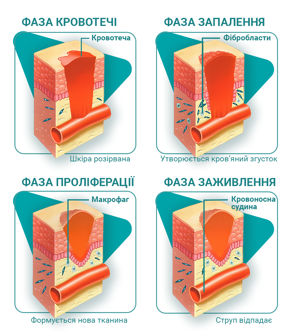 Етапи загоювання рани.png Рвана рана