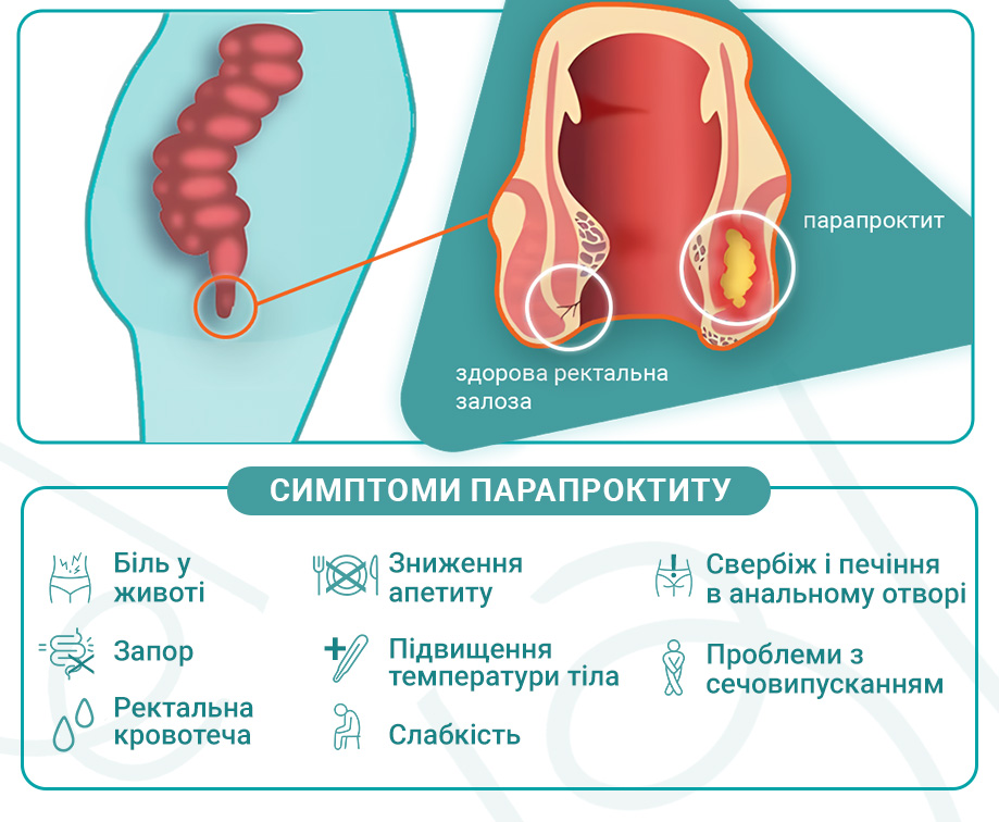 Симптоми парапроктиту.jpg Симптомы парапроктита