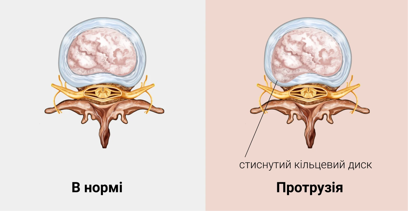 Протрузия