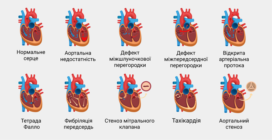 Классифікація вад сердця