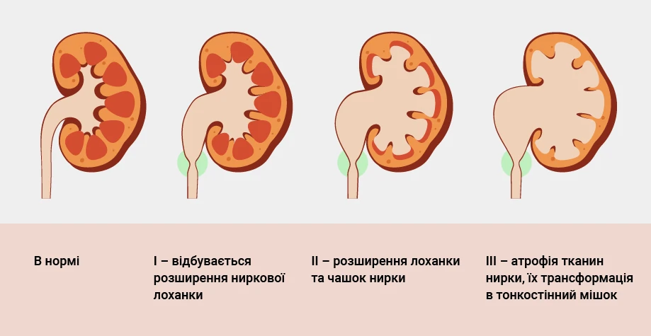 Гідронефроз