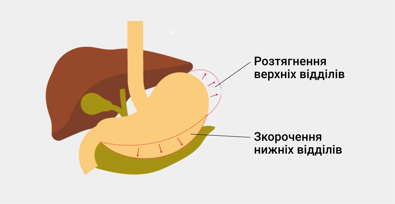 Лечение функциональной диспепсии