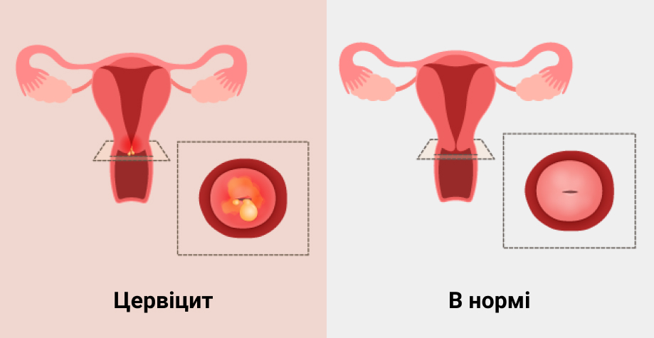 endometrium rák gpc 2022 papilloma ugola tumor