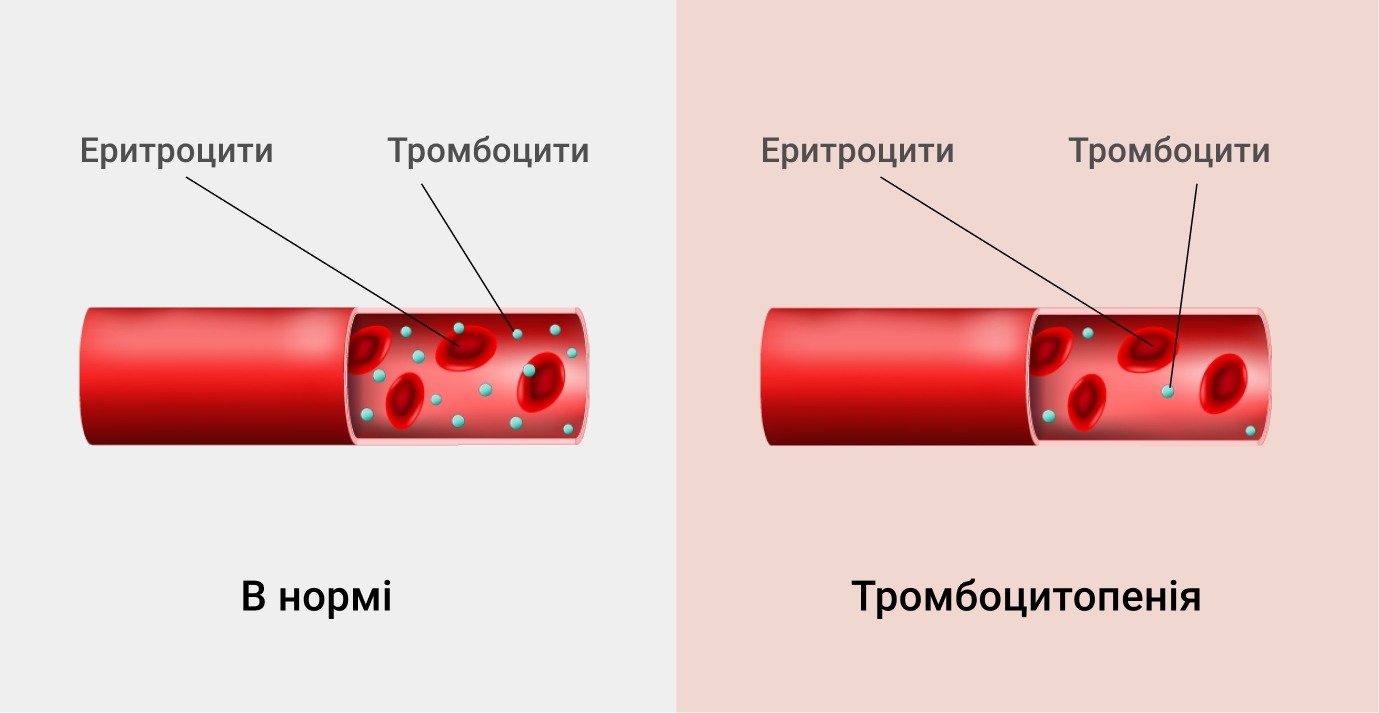 Симптоми тромбоцитопенії