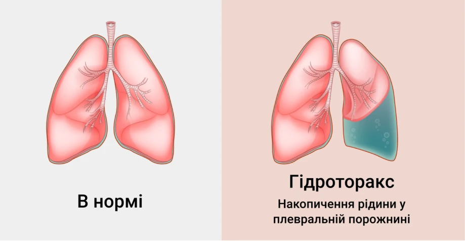 Симптоми гідроторакса