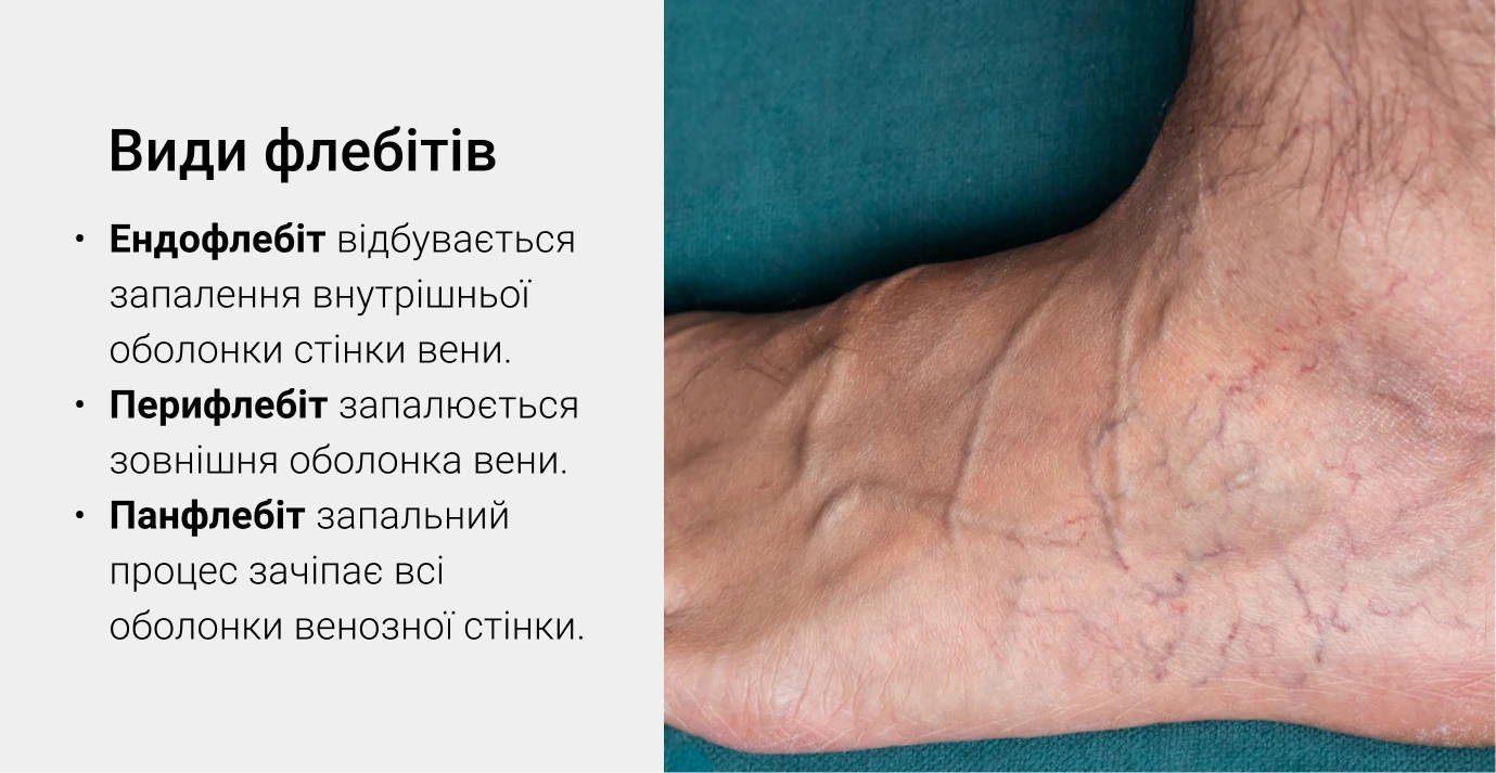 Види флебіту