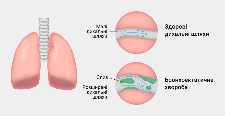 Бронхоектази