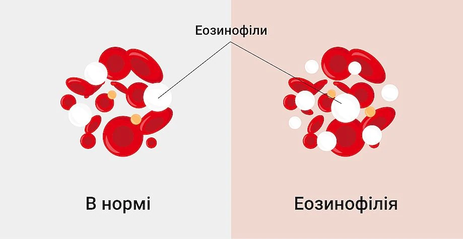 Патогенез эозинофилии