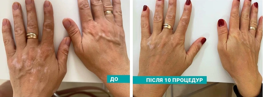 витилиго до и после