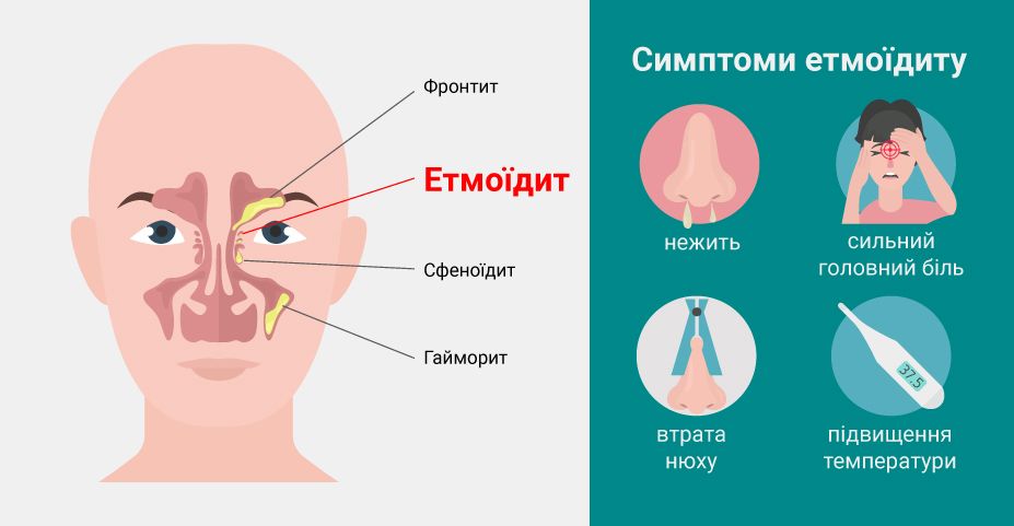 Симптомы этмоидального синусита