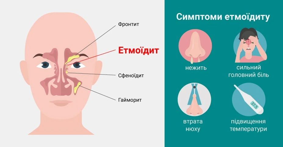 Симптомы этмоидального синусита