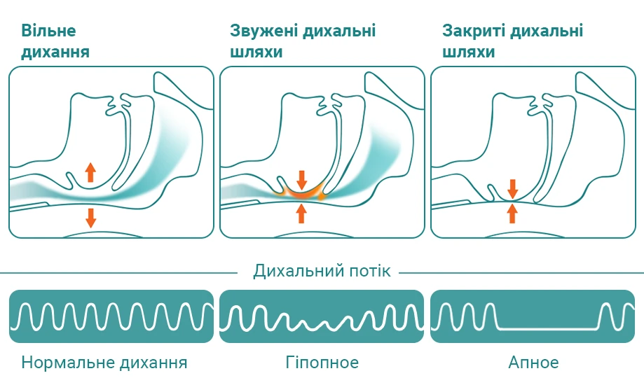 апное сна